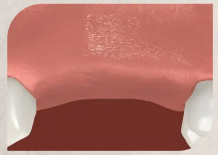Single Dental Implants and Bridges 5 Image showing multiple missing teeth in the mouth, highlighting the gap where several teeth are absent, emphasizing the need for dental implants.