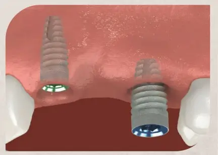 Single Dental Implants and Bridges 6 Illustration showing dental implants being placed into the jawbone beneath the gum line, a key step in restoring missing teeth with dental implants.