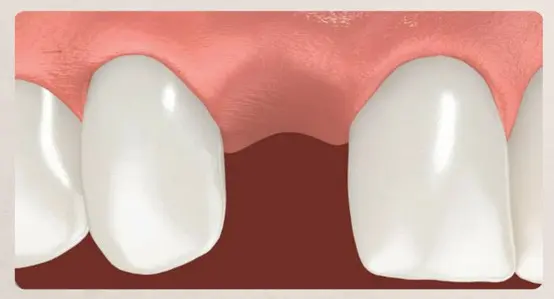 Single Dental Implants and Bridges 2 Image showing a single missing tooth in the mouth, highlighting the space where the tooth is absent.