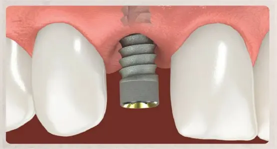 Single Dental Implants and Bridges 3 Illustration showing a dental implant being placed into the jawbone beneath the gum line, preparing for the tooth replacement.