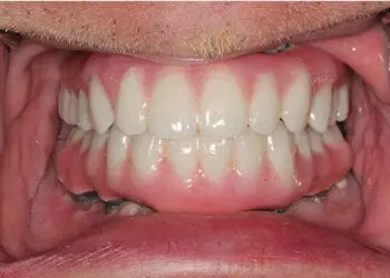 Happy patient sharing their success story after receiving All-on-4 dental implants, highlighting natural results and improved quality of life.