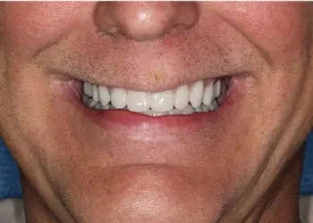 Happy patient sharing their success story after receiving All-on-4 dental implants, highlighting natural results and improved quality of life.