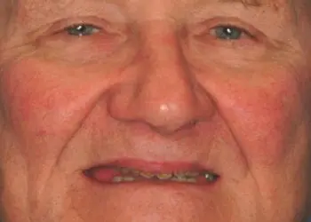 Before and after photos of a patient's All-on-4 dental implant transformation in Memphis, TN, showcasing a brighter and fuller smile.