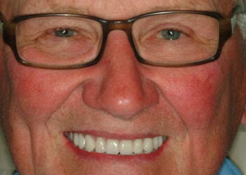 Before and after photos of a patient's All-on-4 dental implant transformation in Memphis, TN, showcasing a brighter and fuller smile.