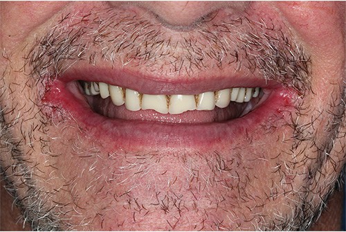 Before and after comparison of a real patient showcasing the transformation with implant-supported snap-on dentures for a confident smile.