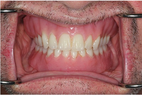 Before and after comparison of a real patient showcasing the transformation with implant-supported snap-on dentures for a confident smile.