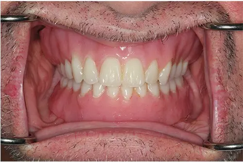 Snap-On Dentures 4 Before and after comparison of a real patient showcasing the transformation with implant-supported snap-on dentures for a confident smile.