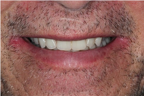 Before and after comparison of a real patient showcasing the transformation with implant-supported snap-on dentures for a confident smile.