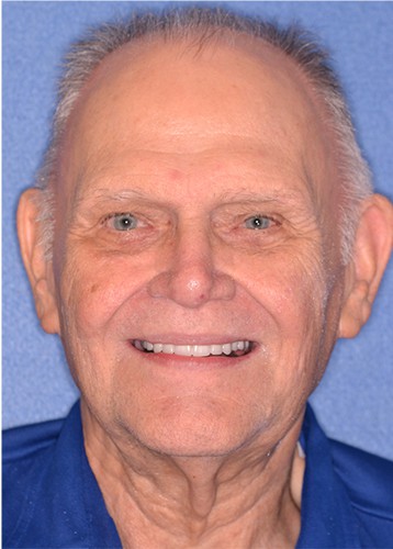 Happy patient at Advanced Dental Implant & TMJ Center smiling after successful snap-on denture treatment, highlighting real results.