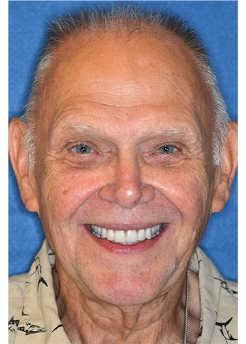 Happy patient at Advanced Dental Implant & TMJ Center smiling after successful snap-on denture treatment, highlighting real results.
