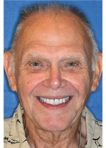 Snap-On Dentures 7 Happy patient at Advanced Dental Implant & TMJ Center smiling after successful snap-on denture treatment, highlighting real results.