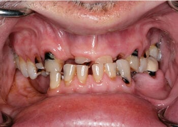 Dr. Adatrow's Patient teeth were badly impacting his speech before All On Four Implants procedure