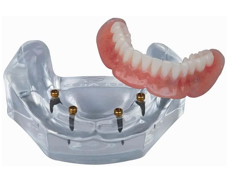 Low cost Lower Snap on Dentures offered by Dr. Adatrow