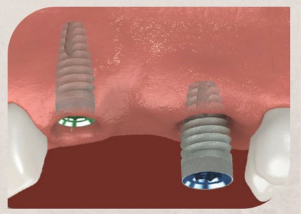 In the Step 2 of Multiple teeth replacements process using Dental Bridges, Implants are placed in the bone beneath the gum