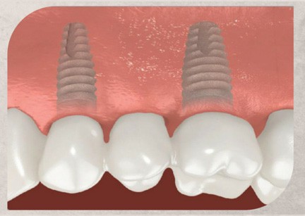 Multiple Teeth Step 3 - Teeth Replacement using Single Dental Implants and Bridges