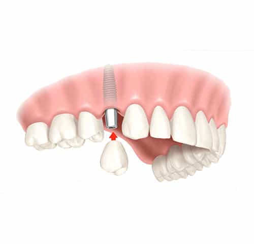 Single Dental Implants