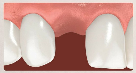 Step 1 of Single tooth replacements process using Single Dental Implant