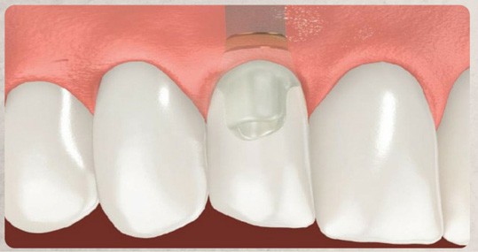 In the Step 3 of Single tooth replacements process using Single Dental Implant, Step 3: Abutment and final crown are made as replacement tooth.