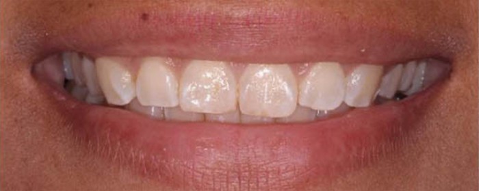Dr. Adatrow's Patient Before Gum contouring with Crown