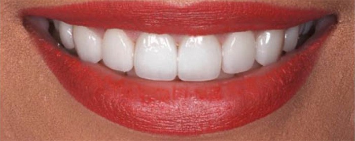 Dr. Adatrow's Patient After Gum contouring with Crown