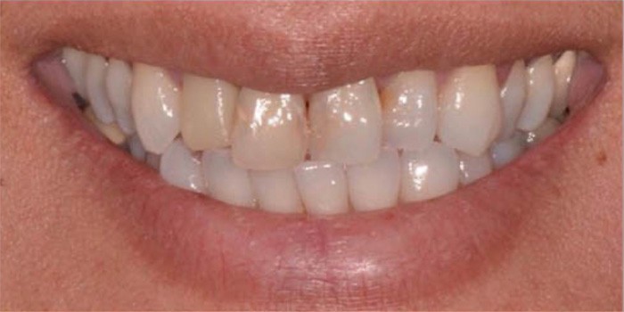 Dr. Adatrow's Patient Before Dental Implants and Crowns