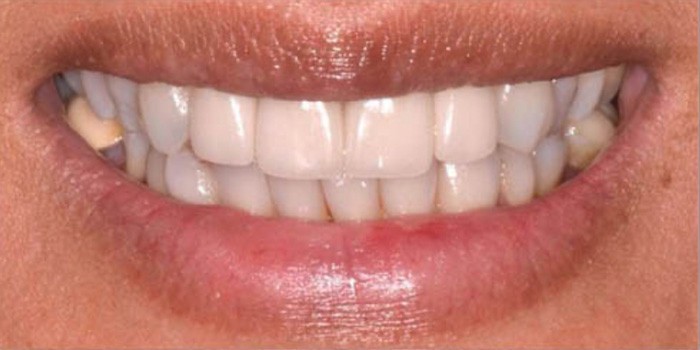 Dr. Adatrow's Patient After Dental Implants and Crowns