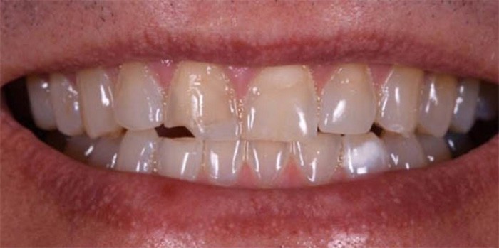 Dr. Adatrow's Patient Before Crown Lengthening and Dental Crowns
