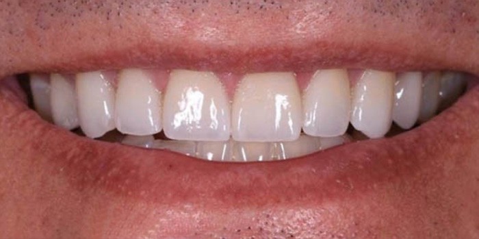 Dr. Adatrow's Patient After Crown Lengthening and Dental Crowns