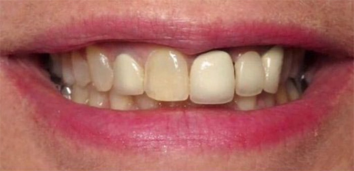Dr. Adatrow's Patient Before Reconstruction with Dental Implants and Dental Crowns