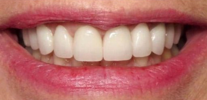 Dr. Adatrow's Patient After Reconstruction with Dental Implants and Dental Crowns