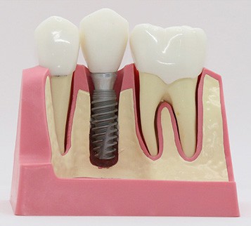  Dental Implants Aftercare