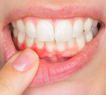 4 gum disease stages