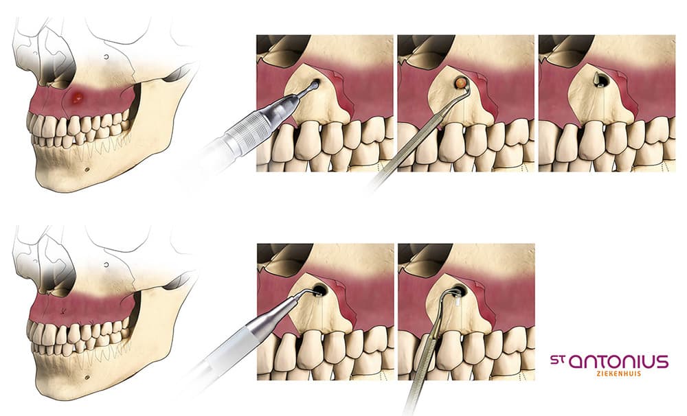 Lowcost and Easy Apicoectomy Process