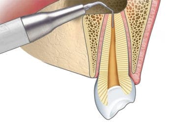 Apicoectomy helps you Save Your Tooth!