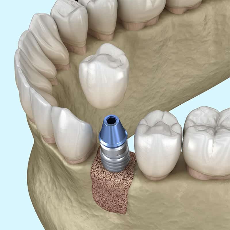 Benefits of Bone Grafting