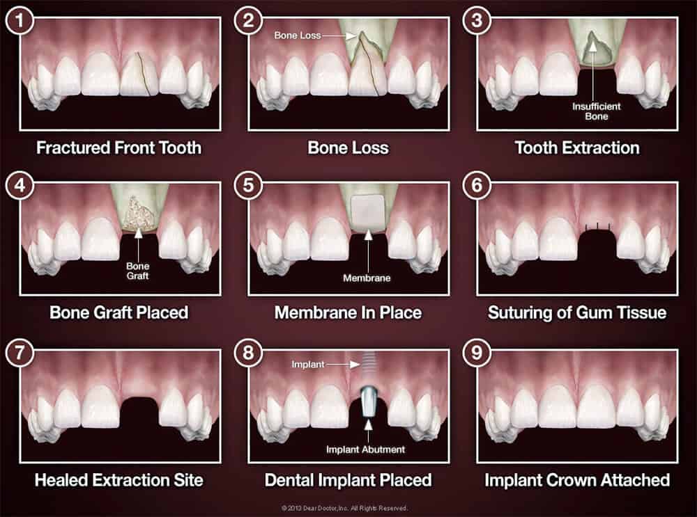 Bone Grafting Process