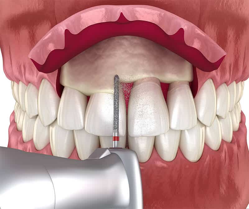 Overall Process of Crown Lengthening Surgery
