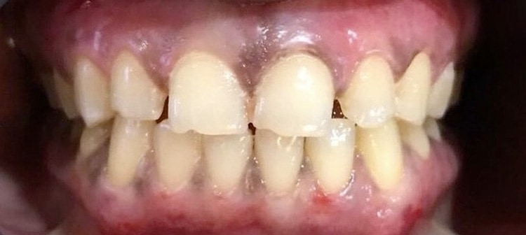 Dr. Adatrow's Patient After Getting Affordable Dark Gums Treatment done