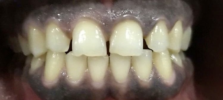 Dr. Adatrow's Patient Before Getting dark gums treatment done