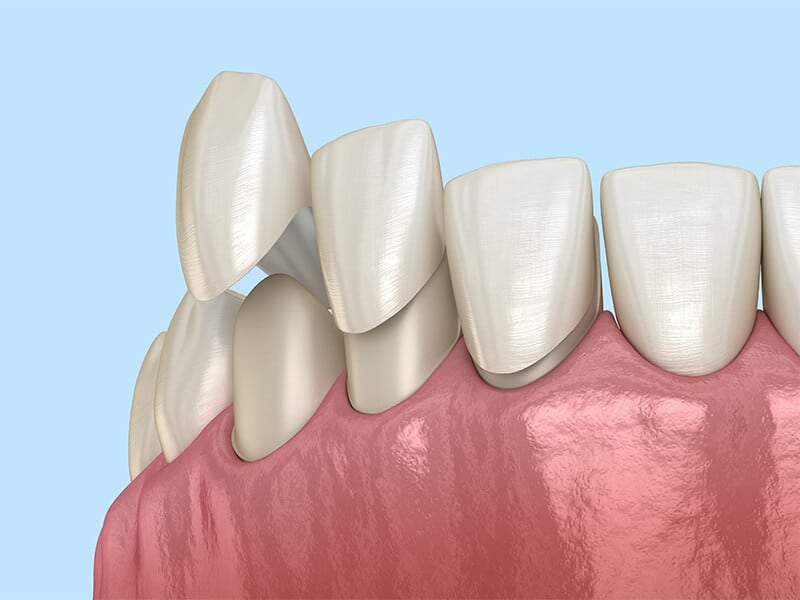 Dental Veneers Installation Procedure explained by Dr. Adatrow