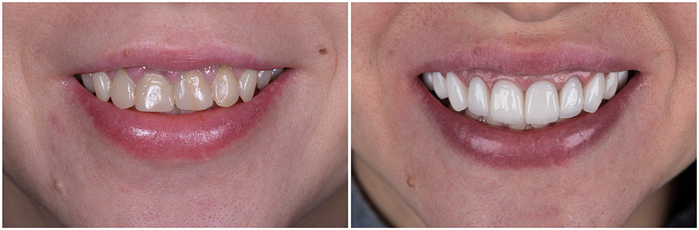 Dr. Adatrow's Patient before and after getting Dental Veneers for smile restoration