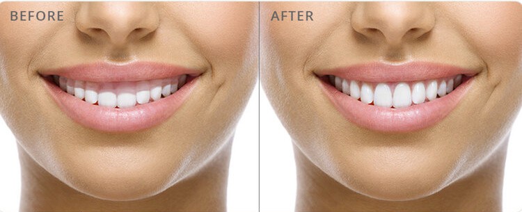 Esthetic Crown Lengthening Treatment