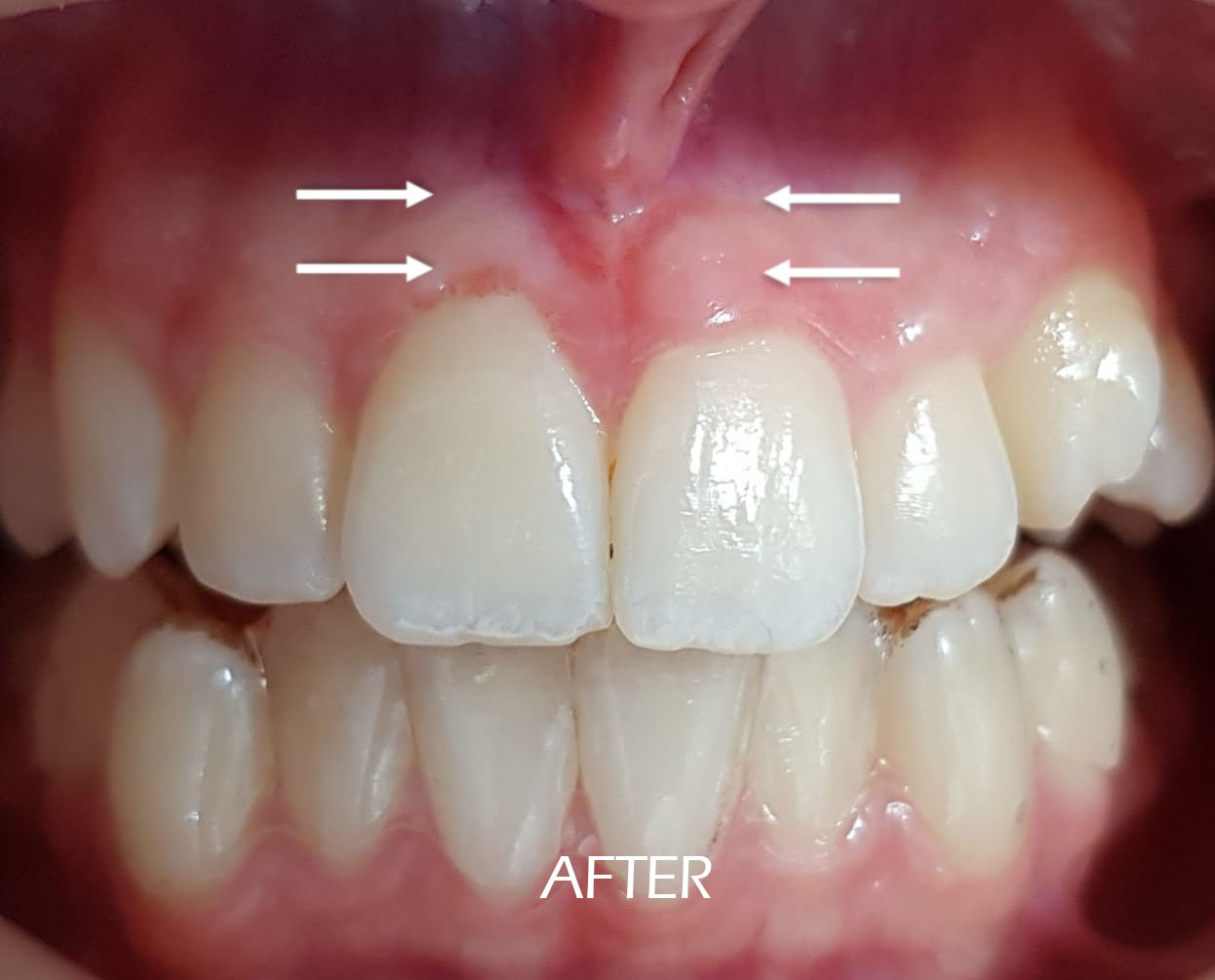 Figure 3 from Management of maxillary labial frenum and comparison between  conventional techniques and incision-below the-clamp technique : case  report | Semantic Scholar, image size:1246x1005