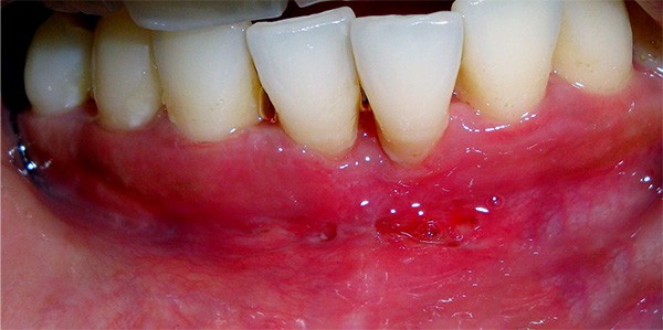 Dr. Adatrow's Patient after getting Frenectomy treatment