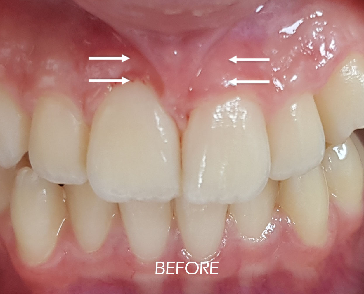 Before and after results of a frenectomy procedure at Advanced Dental & TMJ Center, showcasing improved oral mobility and comfort in patients with tongue-tie or lip-tie. Before Frenectomy