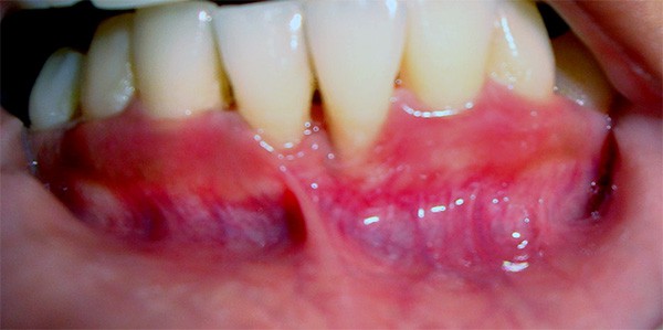 Dr. Adatrow's Patient Before getting Frenectomy treatment