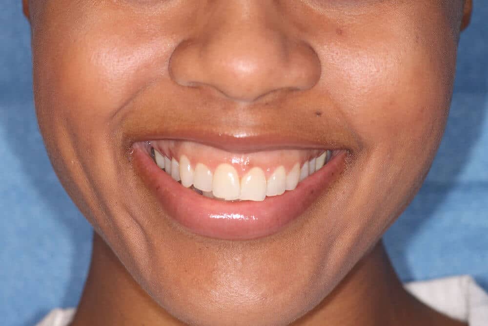 Dr. Adatrow's Patient Before Gum contouring with Lip Positioning