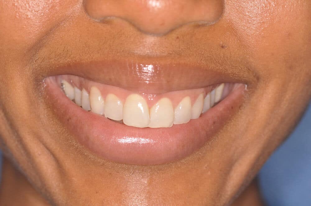 Dr. Adatrow's Patient After Gum contouring with Lip Positioning