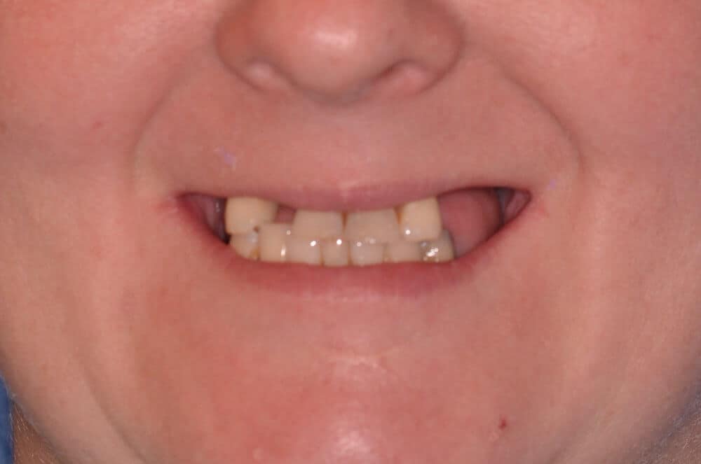 Dr. Adatrow's Patient Before Smile Reconstruction with dental implants