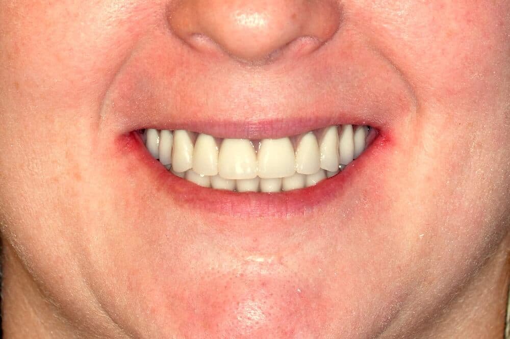 Dr. Adatrow's Patient After Smile Reconstruction with dental implants